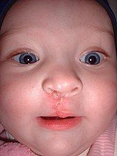 bilateral cleft palate, cleft palate picture, cleft lip picture, cleft palate picture articles, ectodermic dysplasia anhidrotic cleft lip, polydactyly and cleft lip