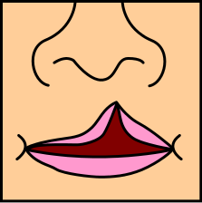 Cleft lip, palate