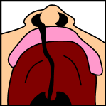 What is a cleft palate