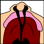 harelip cleft lip, tessier cleft lip and palate, bilateral cleft palate, cleft palate picture, cleft lip picture, cleft palate picture articles