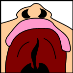 submucous cleft palate, macrosomia microphthalmia cleft palate, dominant cleft palate, harelip cleft lip, tessier cleft lip and palate