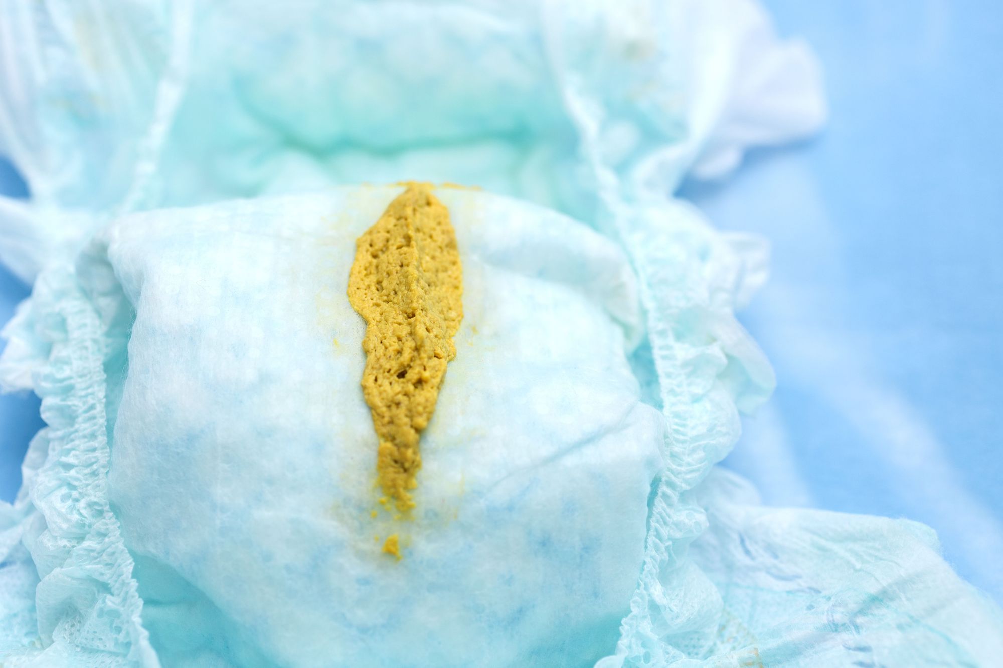 Breastfed Baby Poop Has Chunks