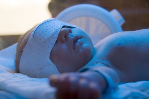 jaundiced baby, Bilirubin Lights, phototherapy