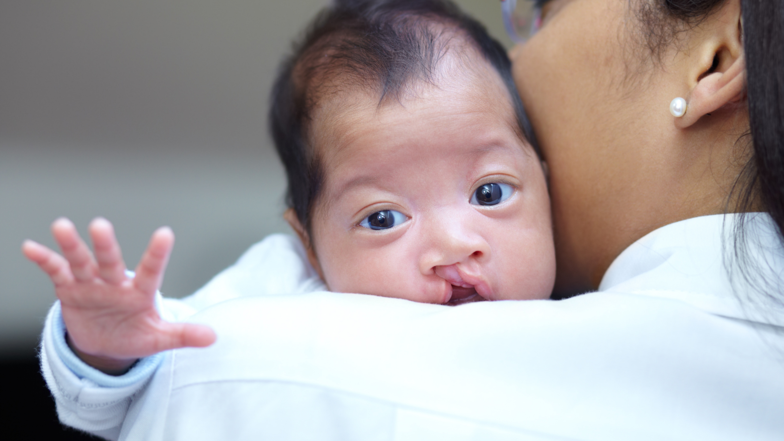 Baby with a cleft lip