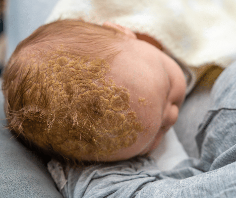 bad cradle cap, baby cradle cap picture