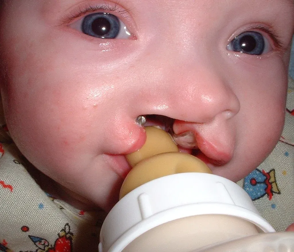 baby with cleft lip